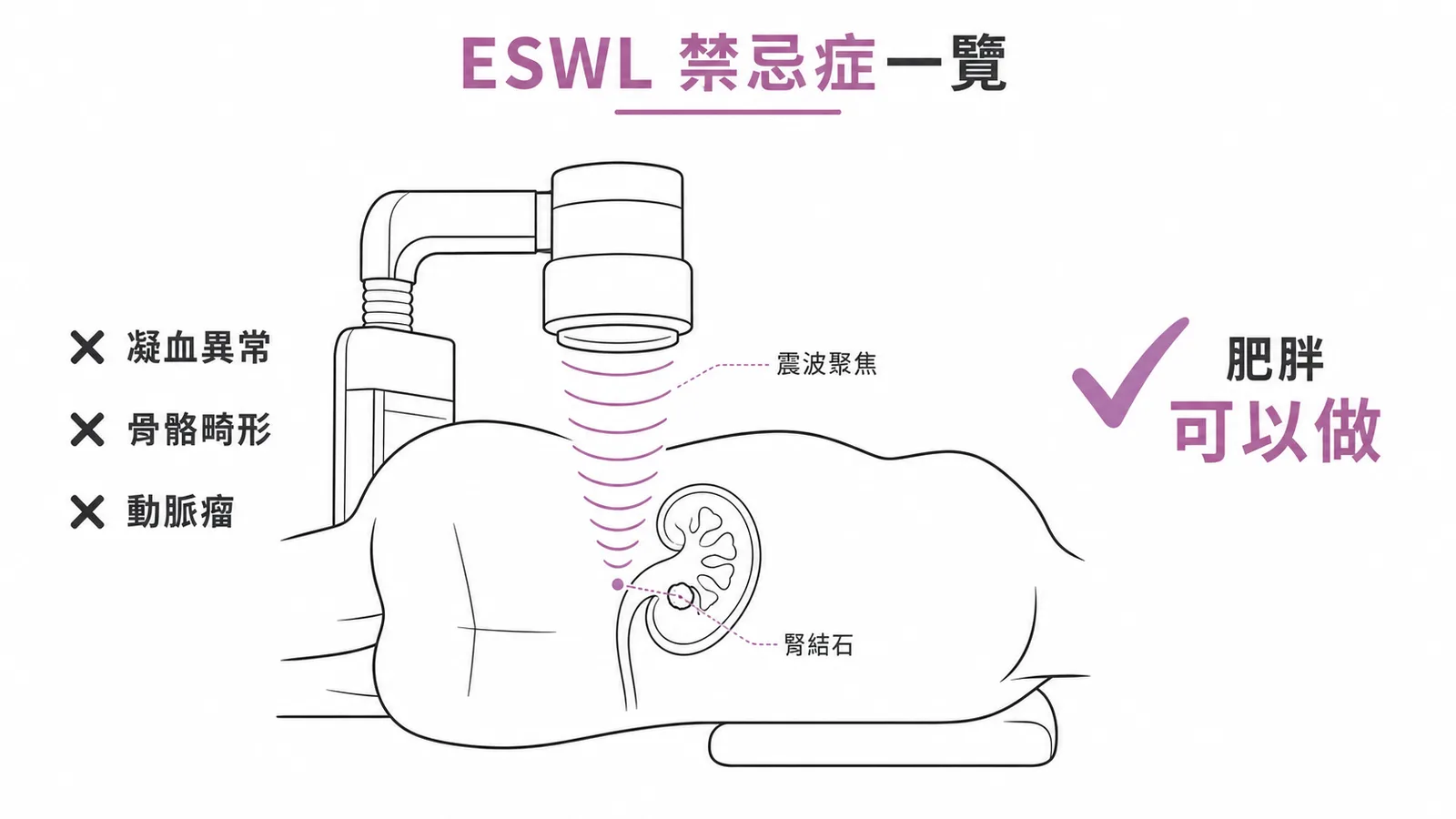 ESWL禁忌症與非禁忌症紅綠燈對照示意圖
