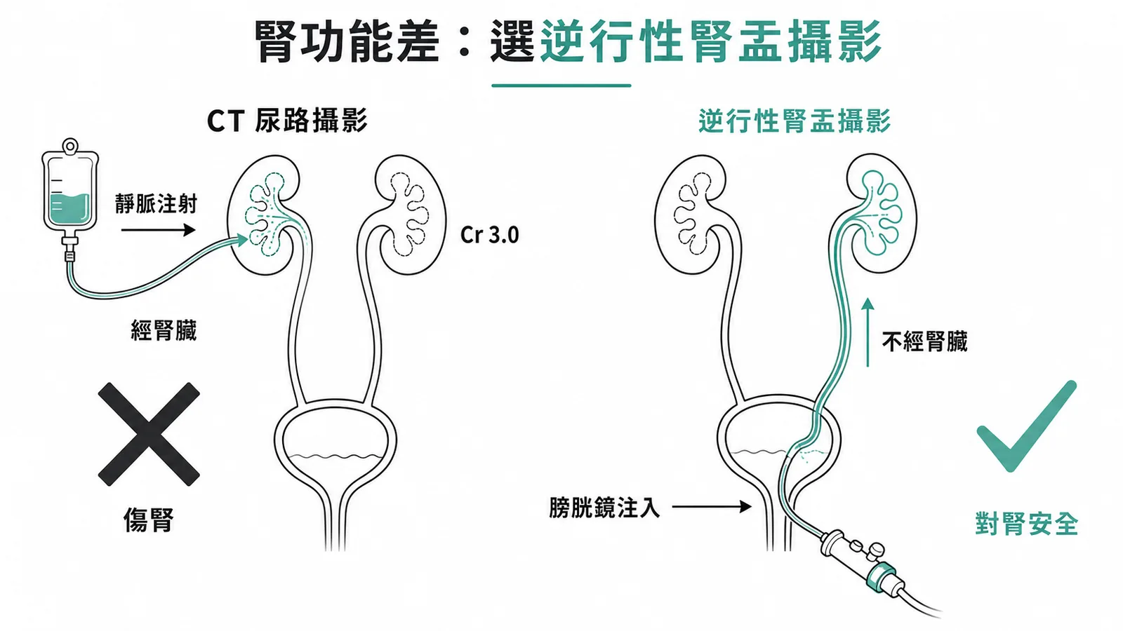 腎功能差時CT urography與逆行性腎盂攝影的對比示意圖