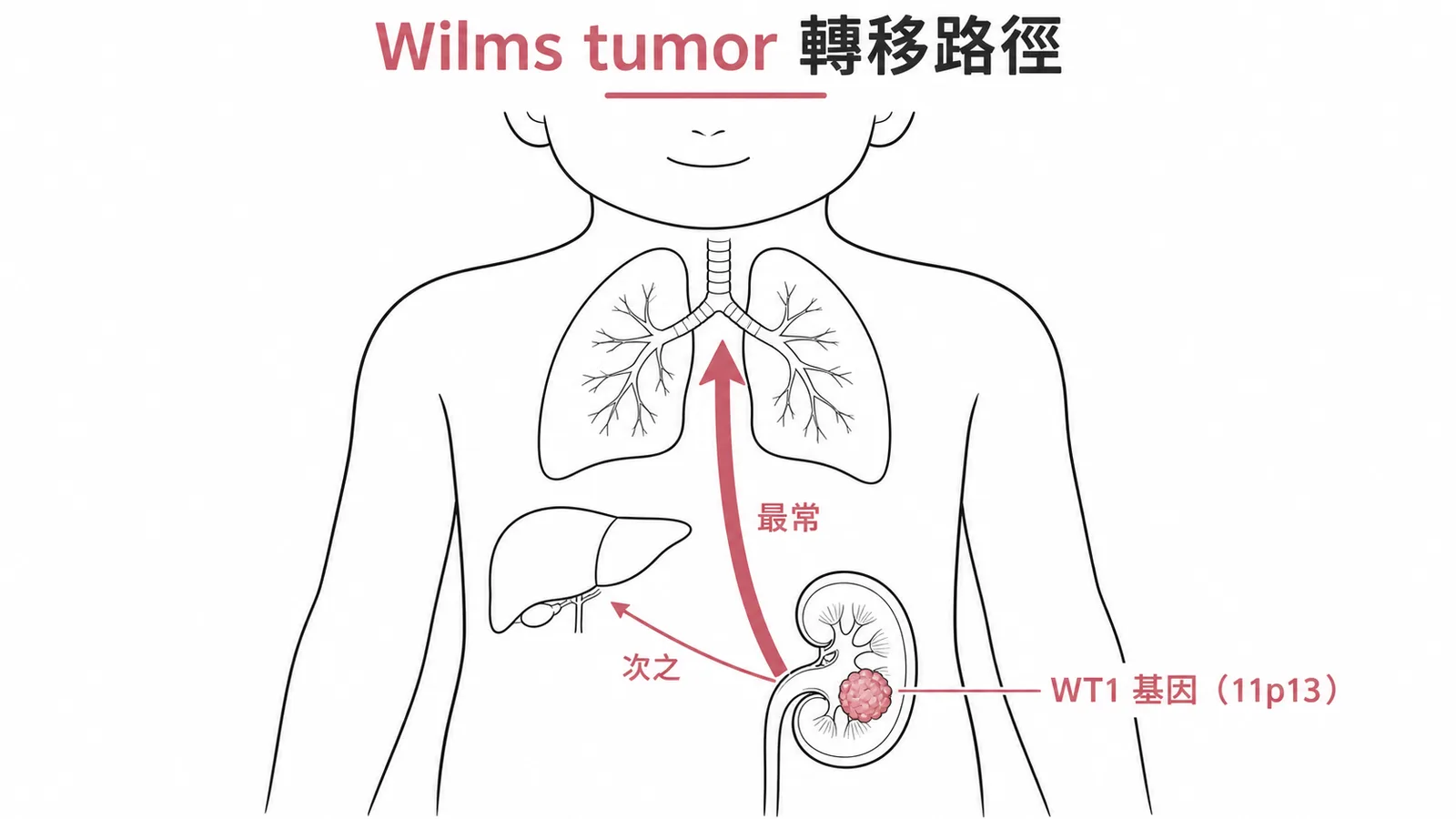 Wilms tumor從腎臟轉移至肺臟和肝臟的路徑示意圖