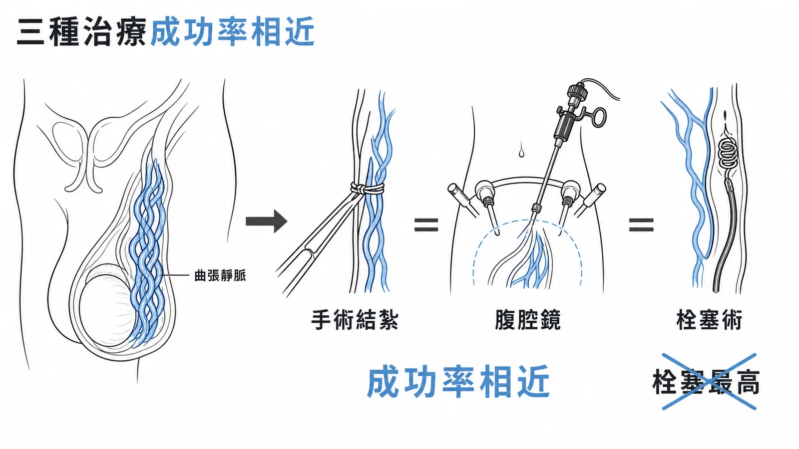 精索靜脈曲張三種治療方式成功率相近的對照示意圖