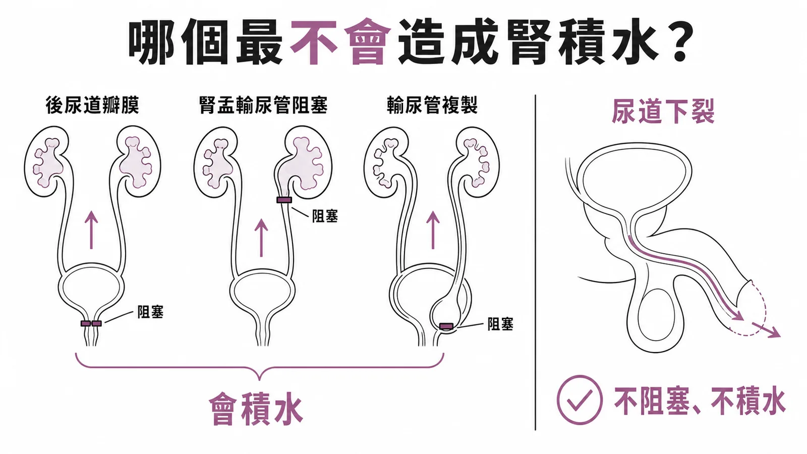 四種先天泌尿道異常與腎積水關係的對照示意圖