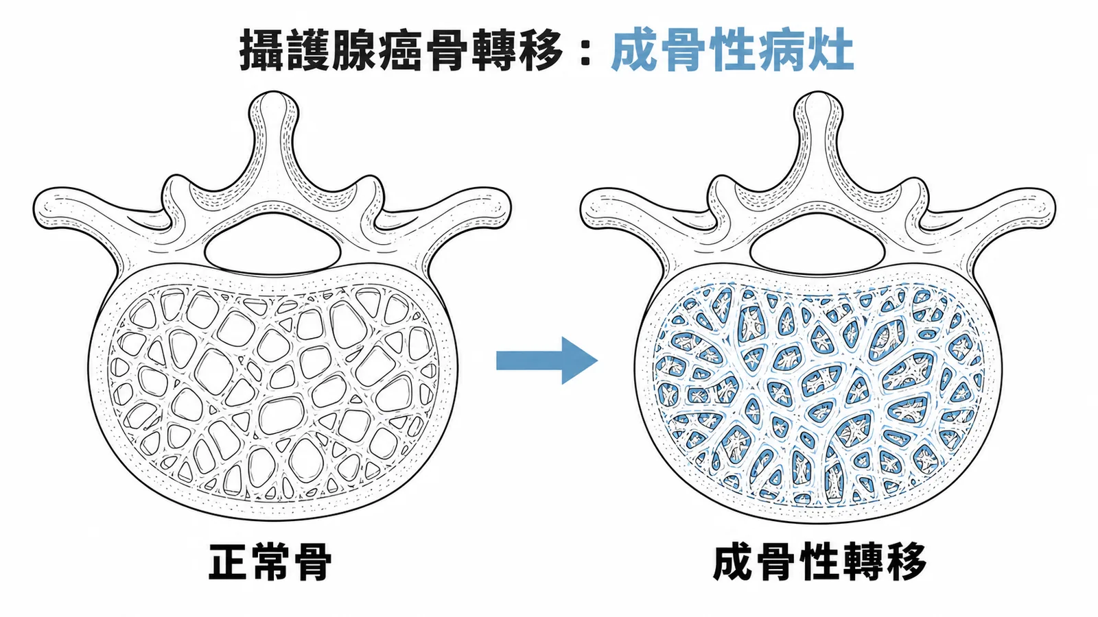 攝護腺癌骨轉移為成骨性病灶，骨質增生變密