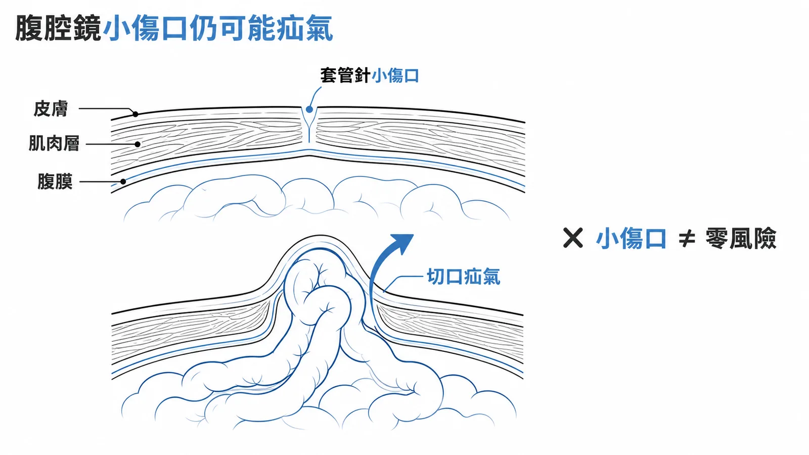 腹腔鏡套管針傷口癒合不良仍可形成切口疝氣