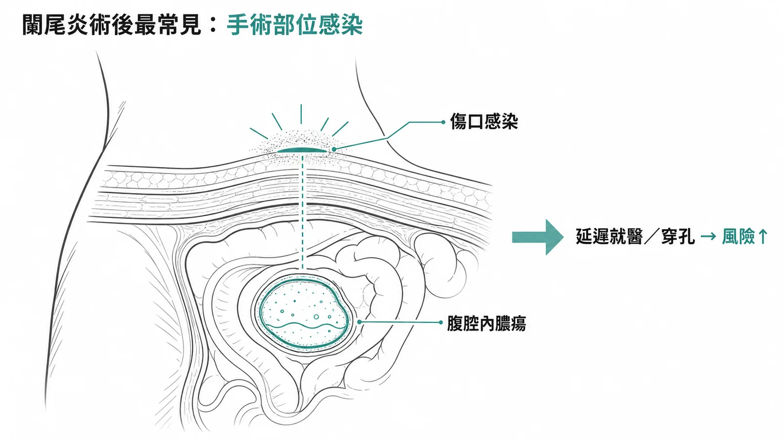 闌尾炎術後最常見併發症為手術部位感染包含傷口感染與腹腔膿瘍