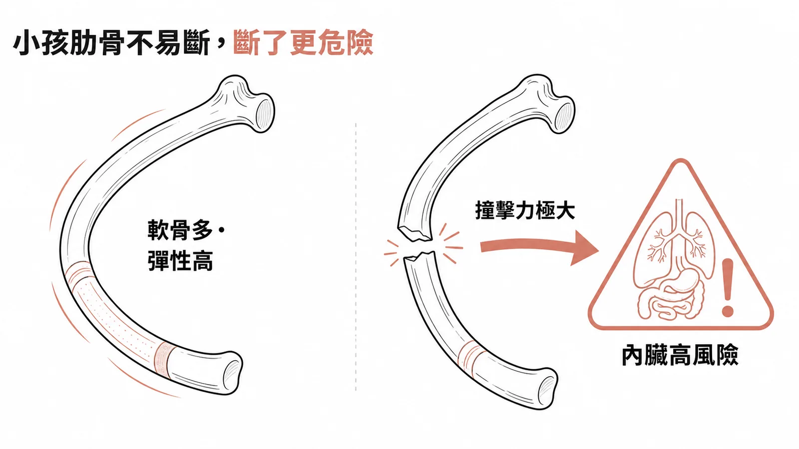 小孩肋骨彈性高不易斷但骨折代表撞擊力極大內臟高風險