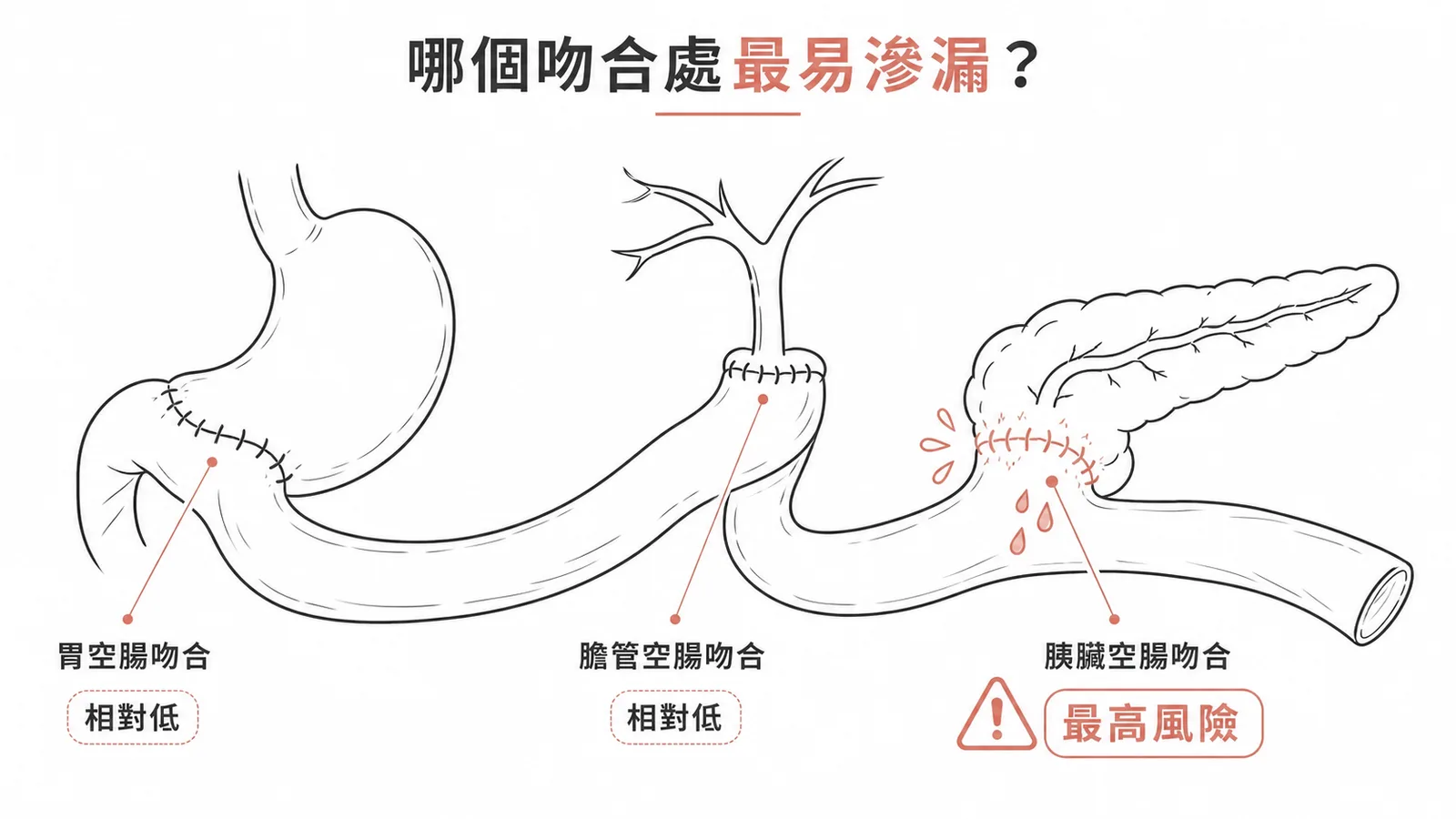 Whipple術後胰臟空腸吻合處滲漏風險最高
