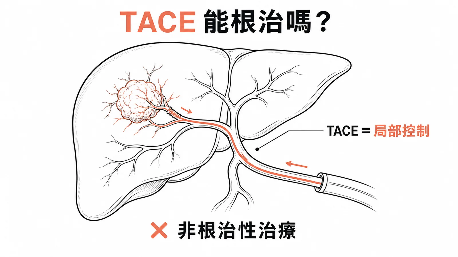 TACE是局部控制而非根治性治療