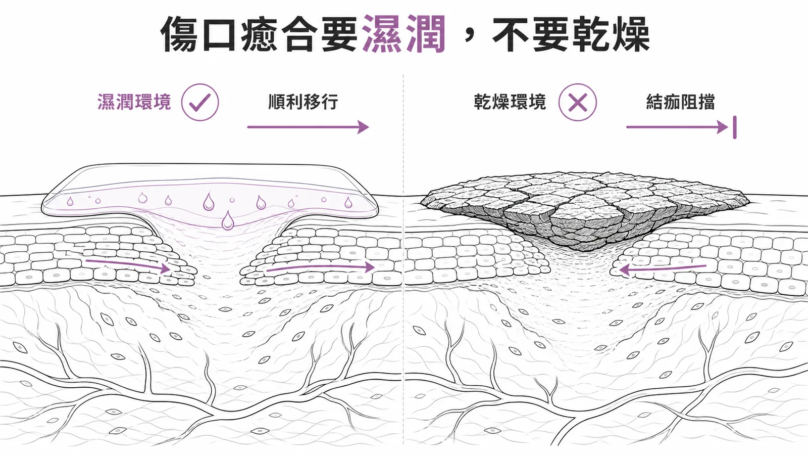 傷口癒合要濕潤不要乾燥