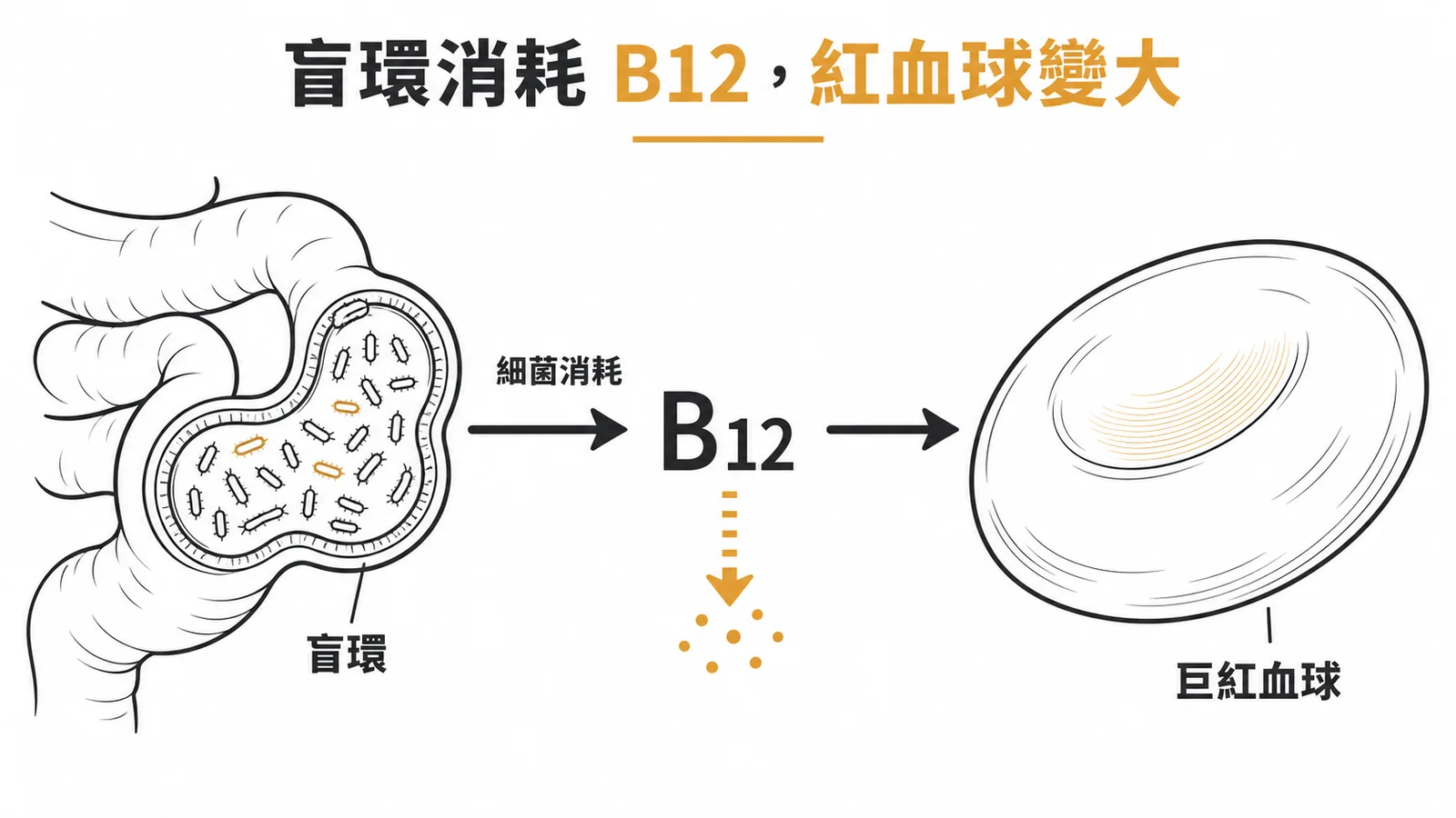 盲環症候群導致B12缺乏與巨紅血球貧血示意圖
