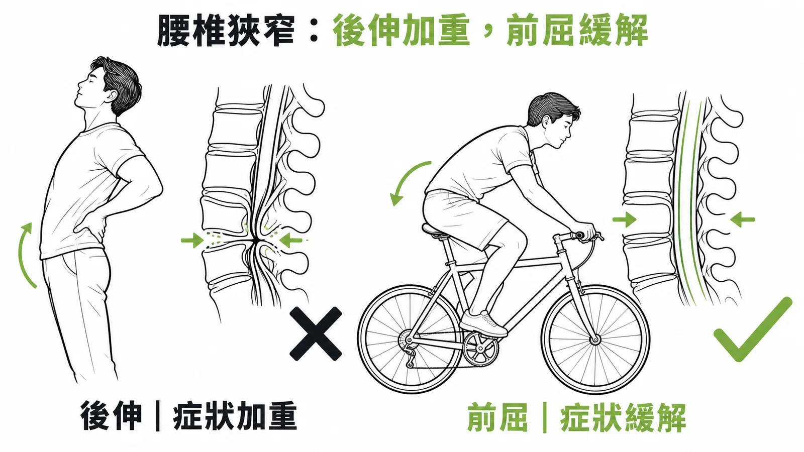 腰椎狹窄後伸加重前屈緩解示意圖