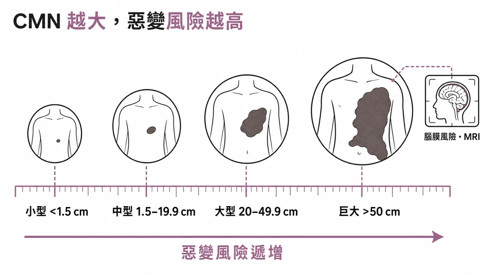 先天性黑色素細胞痣大小分級與惡變風險示意圖