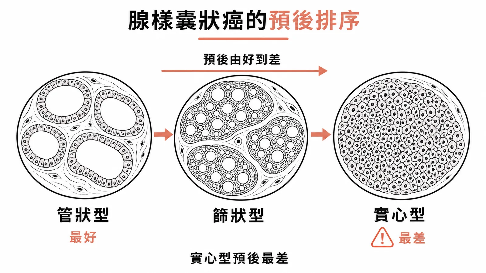 腺樣囊狀癌三種病理型態的預後排序示意圖