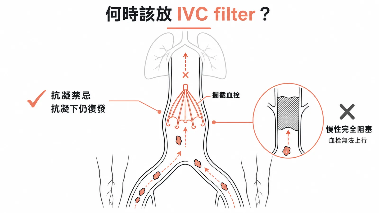 IVC filter適應症與不需要放置情境的對比示意圖
