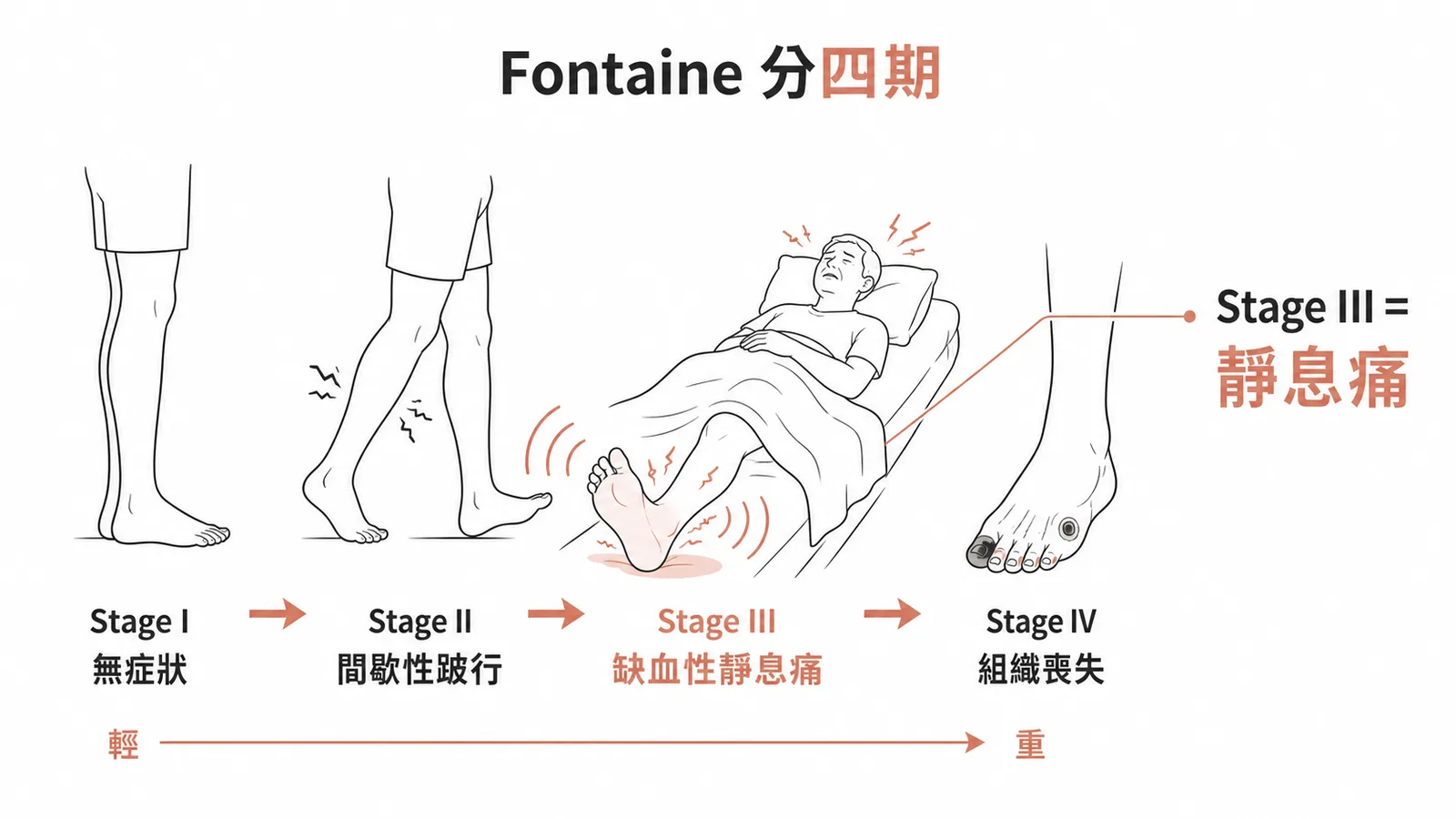 Fontaine分類四期的下肢動脈阻塞疾病症狀進程示意圖