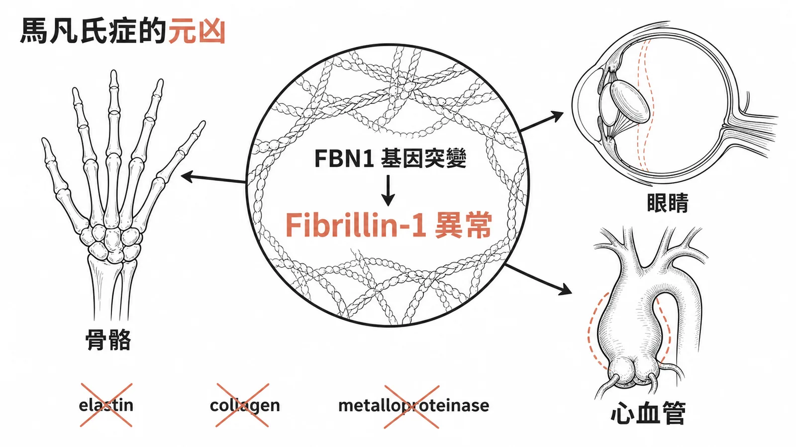 馬凡氏症因FBN1基因突變致Fibrillin-1異常影響三大器官系統示意圖