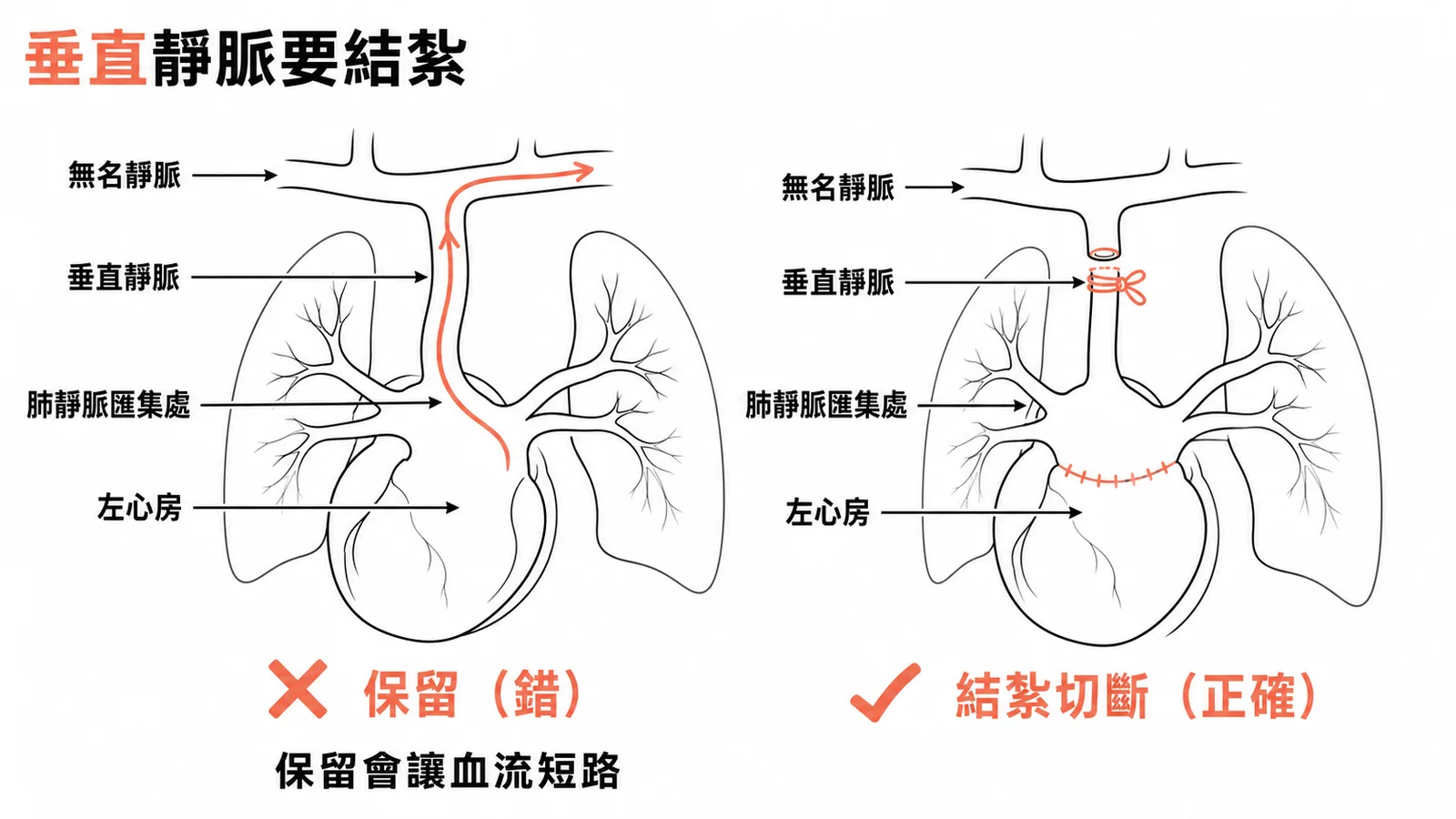 TAPVC手術中垂直靜脈應結紮切斷而非保留的對比示意圖