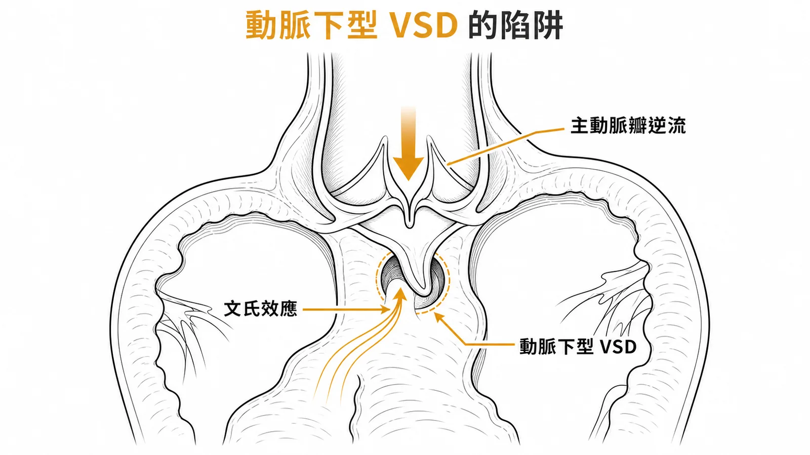 動脈下型VSD因文氏效應導致主動脈瓣脫垂逆流的機轉示意圖