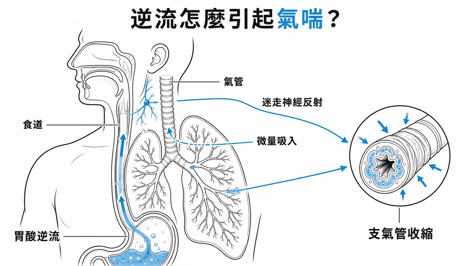 GERD胃酸逆流經迷走神經反射與微量吸入引起氣喘的機轉示意圖