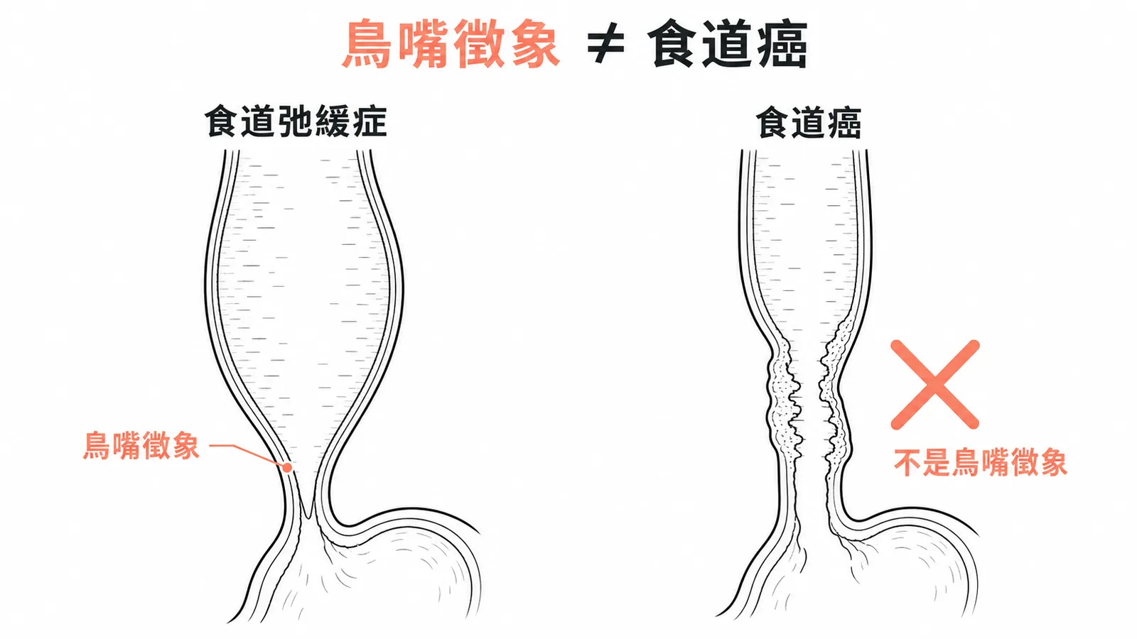 鳥嘴徵象是食道弛緩症而非食道癌的典型影像特徵