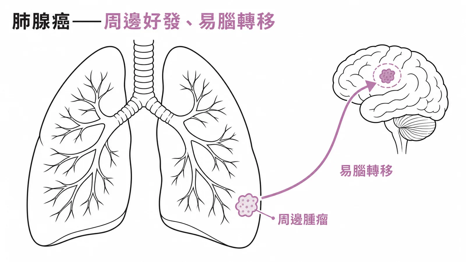 肺腺癌好發於肺部周邊且易發生腦轉移