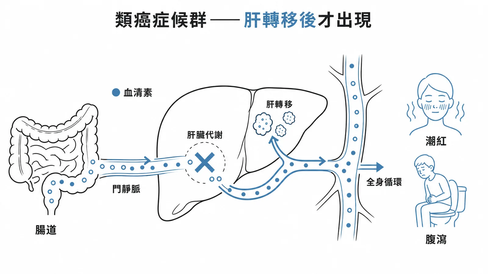 類癌症候群在腫瘤肝轉移後血清素繞過肝臟代謝才出現