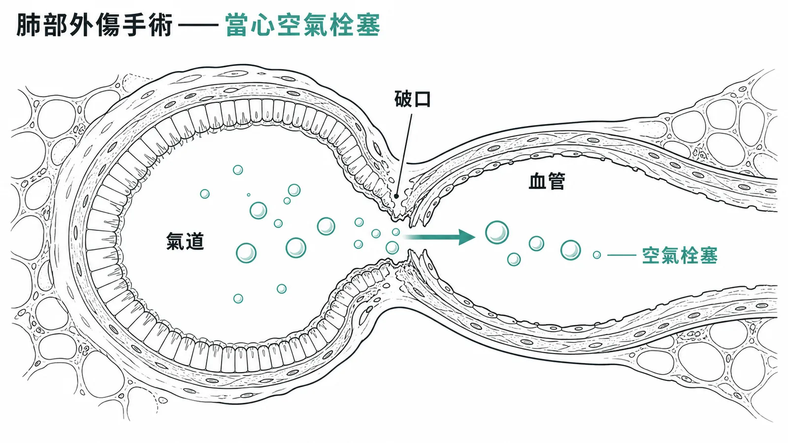 肺部外傷手術中空氣從受損氣道進入血管造成空氣栓塞