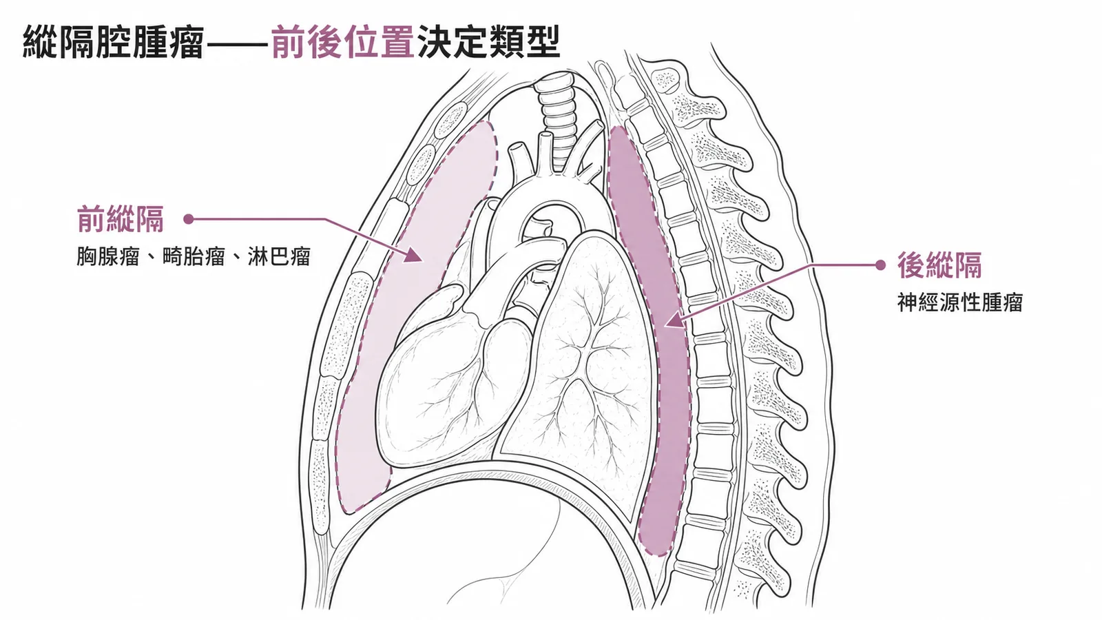 縱隔腔腫瘤依前後位置分類的常見類型