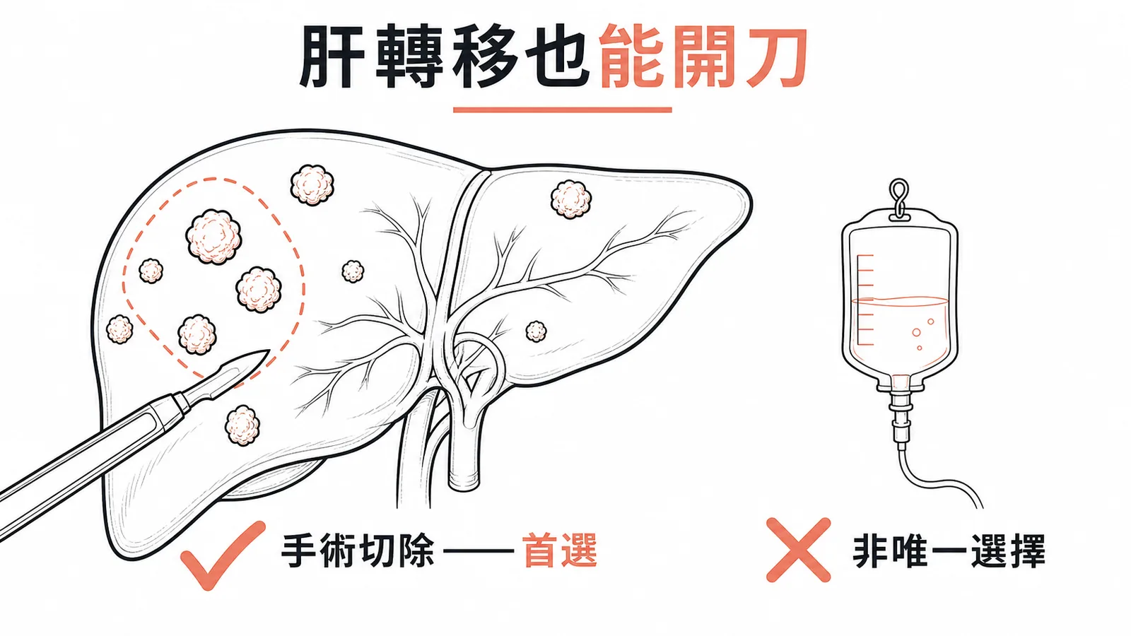 大腸直腸癌肝轉移手術切除為首選而非僅能化療