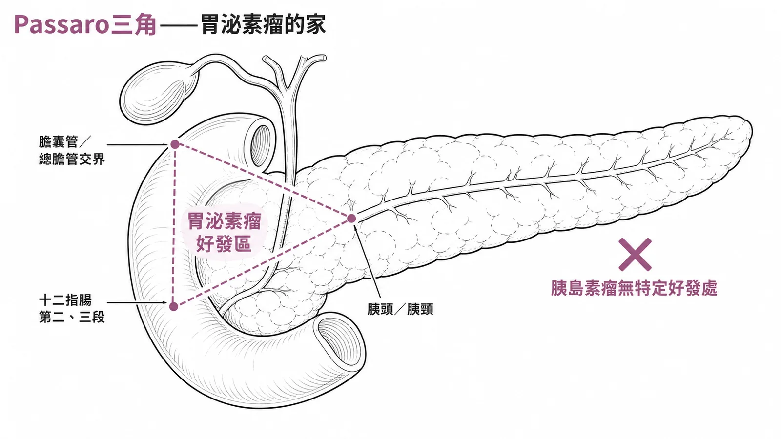 Passaro三角是胃泌素瘤的好發區域而非胰島素瘤