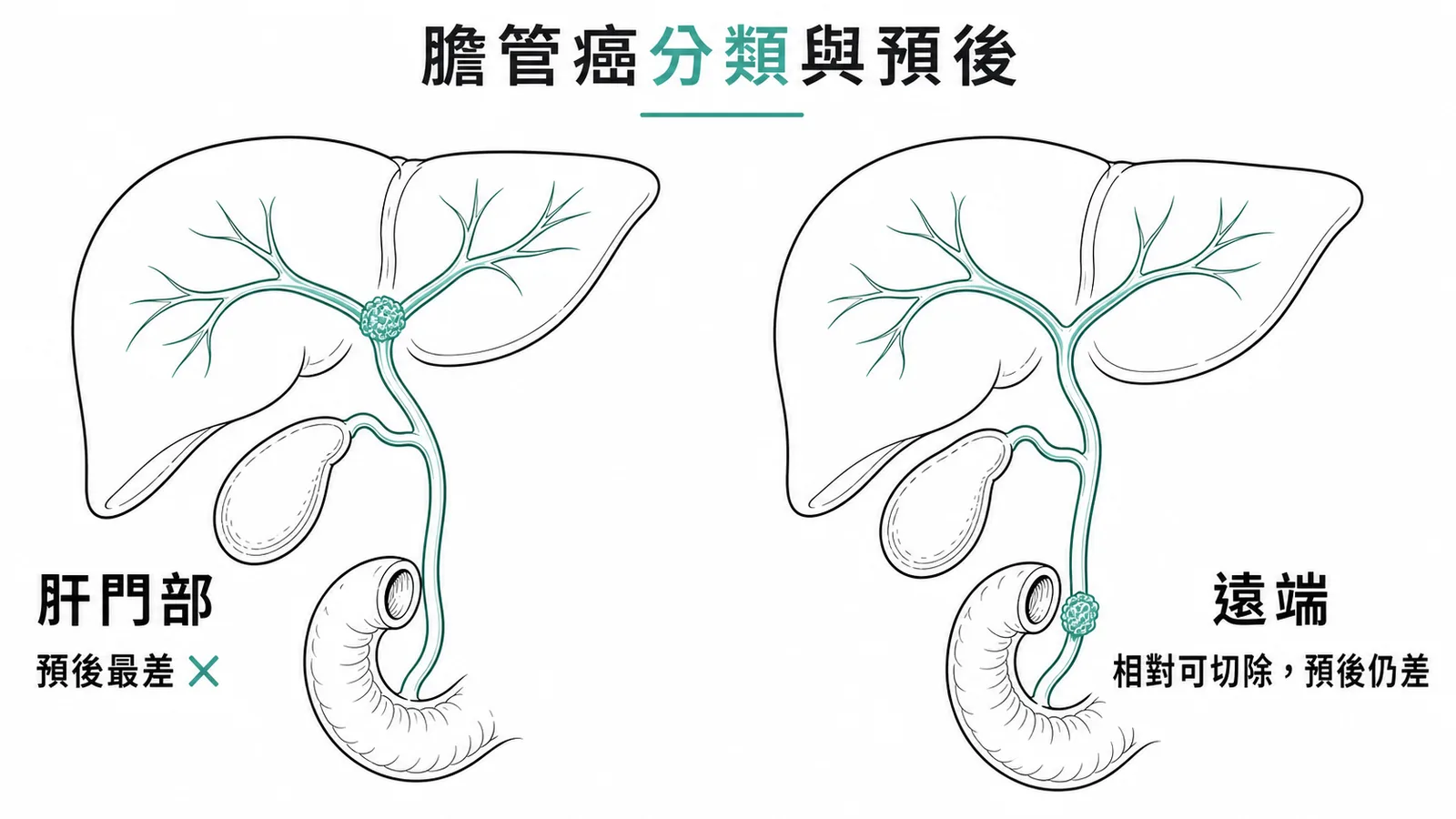 膽管癌依位置分為肝門部與遠端，Klatskin tumor 預後最差