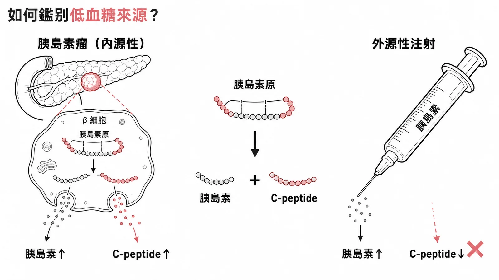 胰島素瘤（內源性）胰島素與 C-peptide 皆升高，外源性注射則 C-peptide 極低