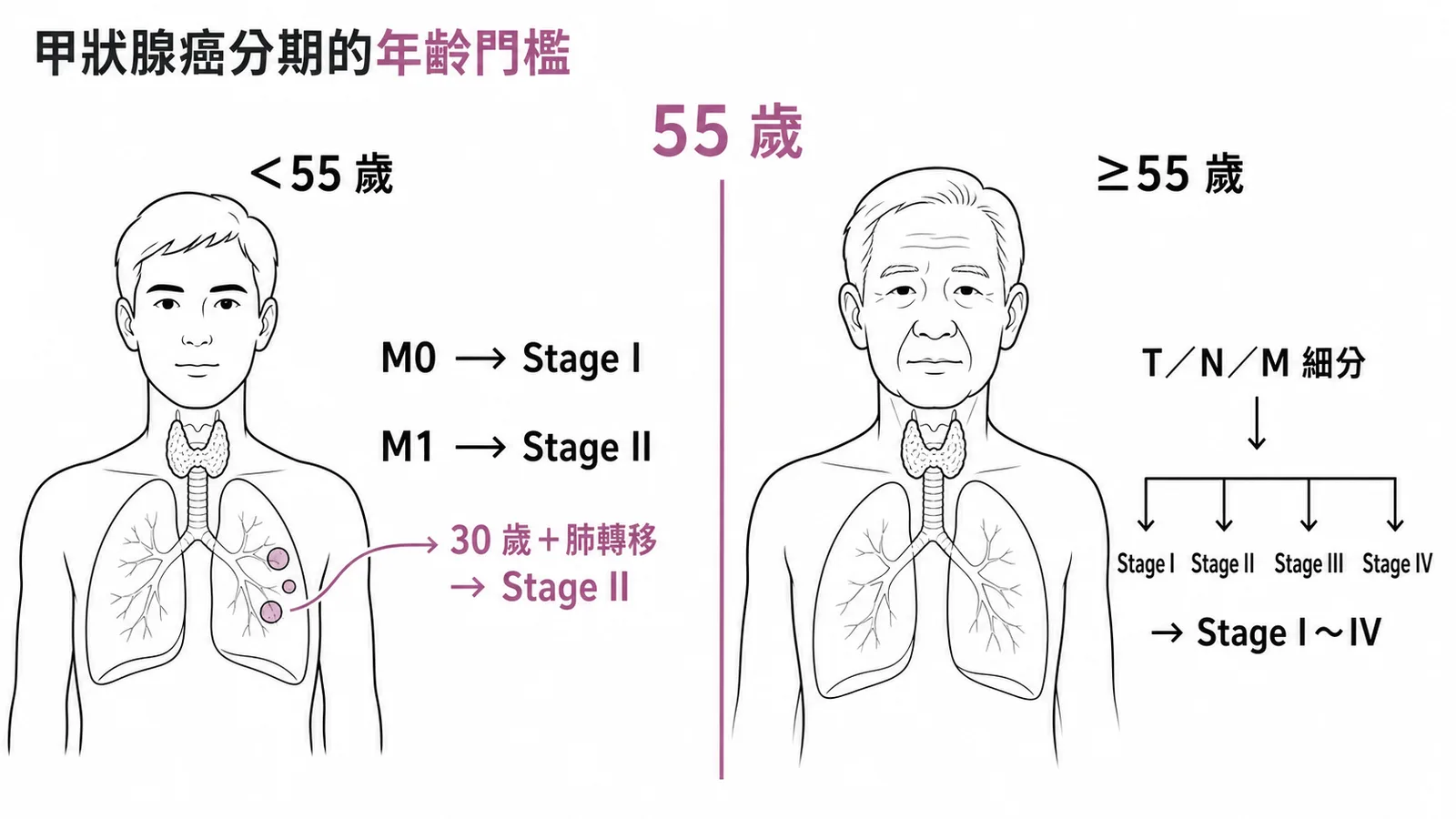 甲狀腺癌 TNM 第八版以 55 歲為分界，＜55 歲有遠端轉移即 Stage II