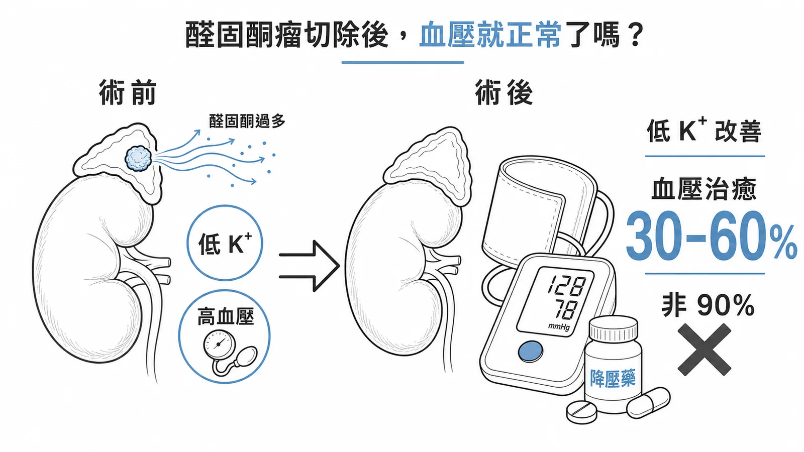 醛固酮瘤切除後低血鉀改善，但高血壓治癒率僅 30-60%、非 90%