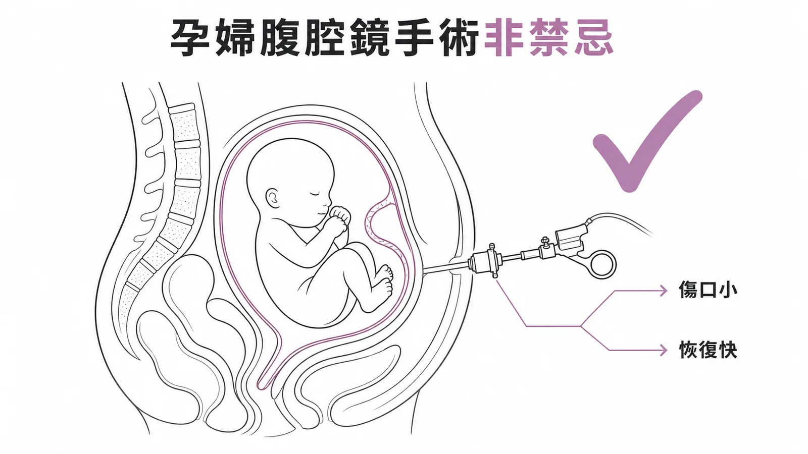 孕婦腹腔鏡手術已非禁忌的示意圖