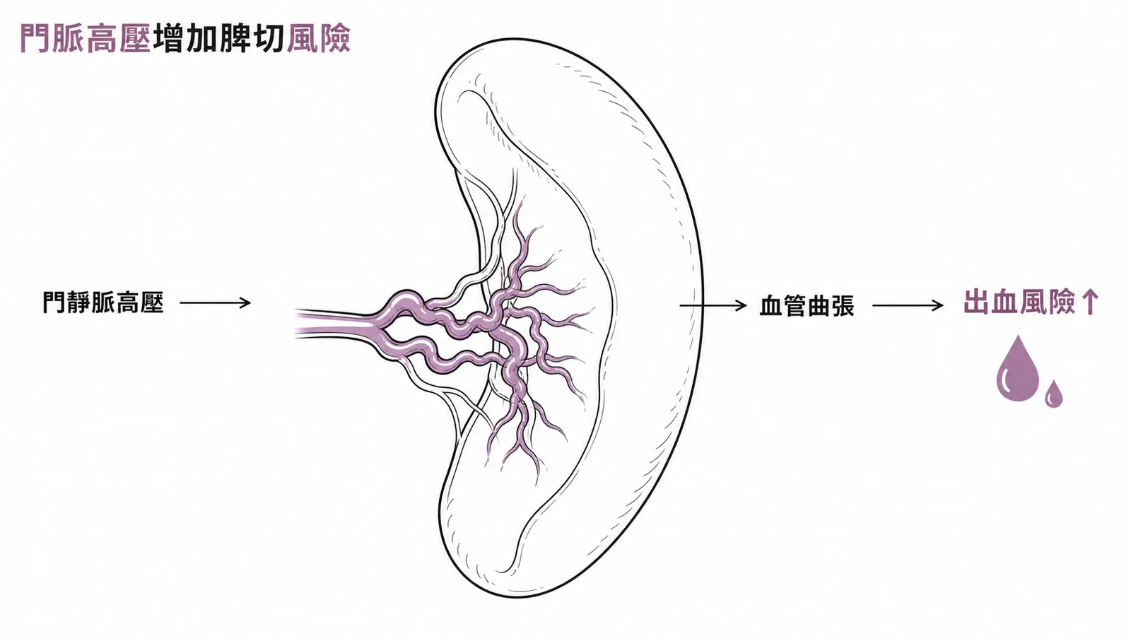 門靜脈高壓導致脾門血管曲張增加脾切除出血風險
