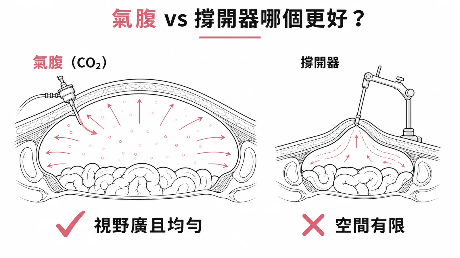 氣腹與撐開器的手術視野對比——氣腹提供更廣且均勻的空間