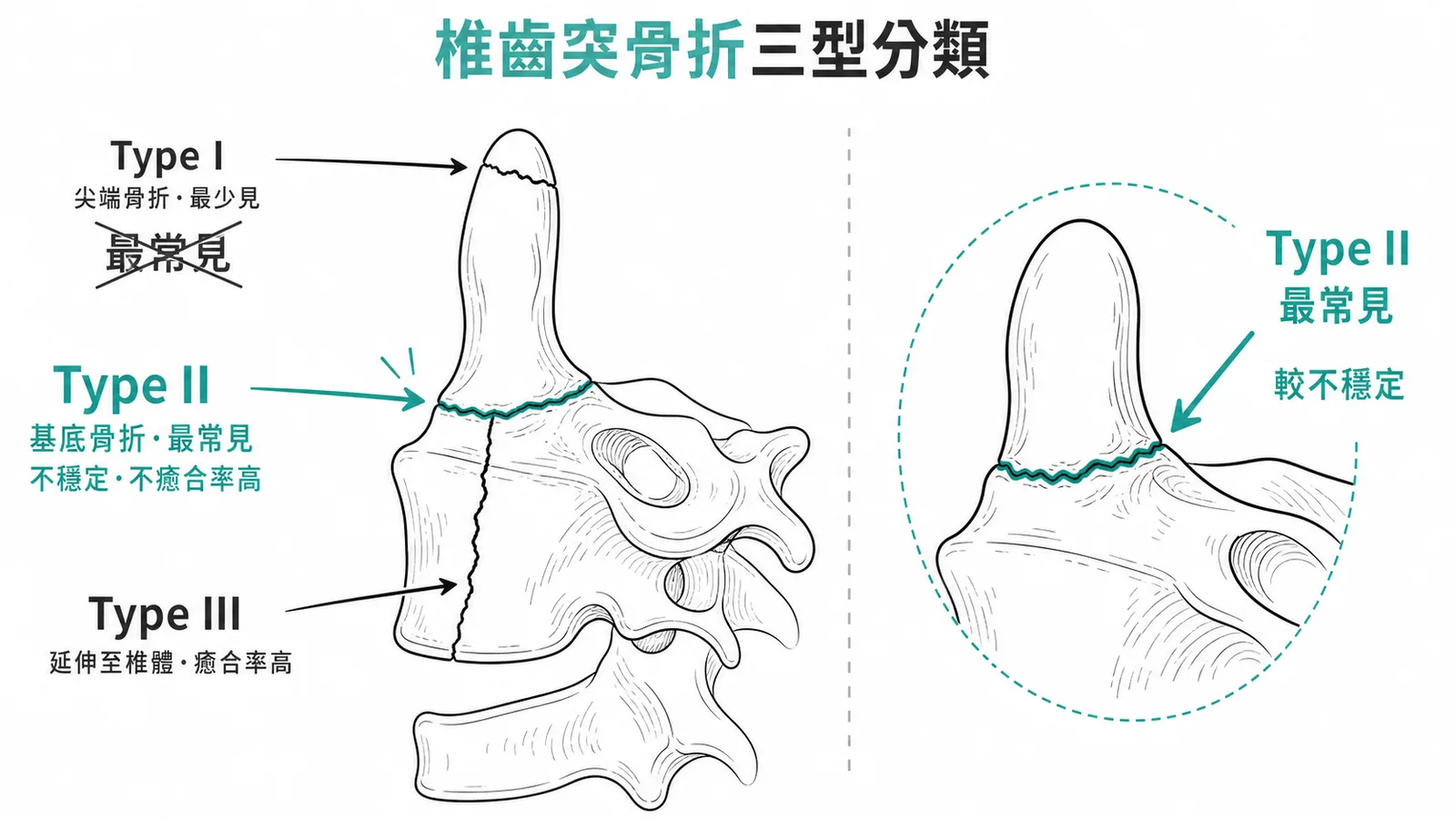 椎齒突骨折 Anderson and D'Alonzo 三型分類