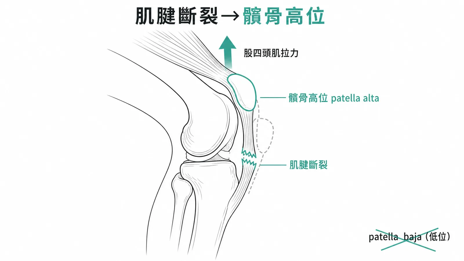 髕骨肌腱斷裂後髕骨向上移位形成 patella alta