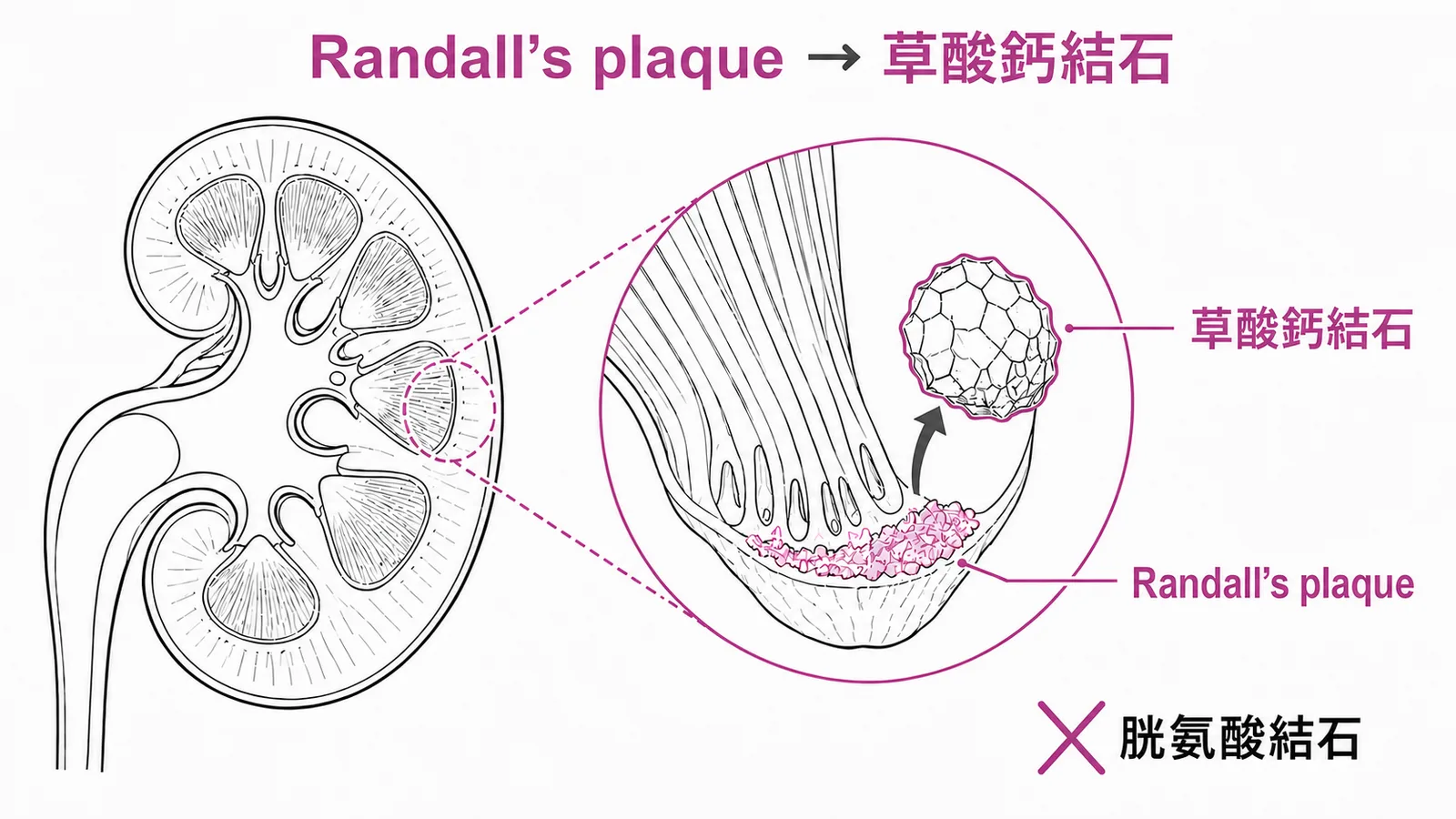 Randall's plaque 與草酸鈣結石形成機制