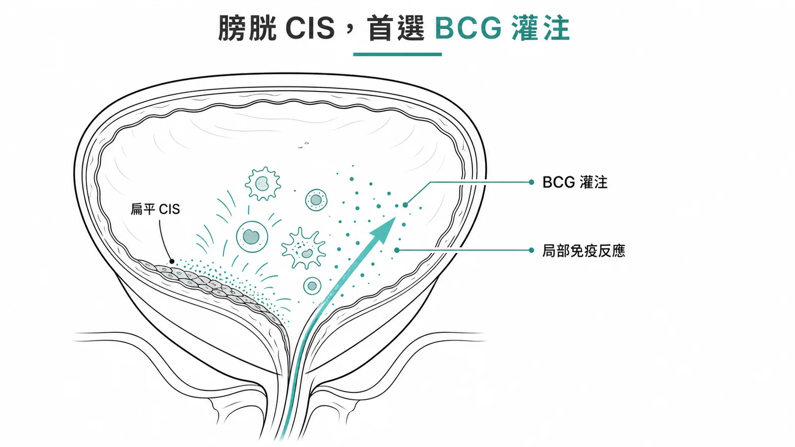 膀胱原位癌CIS首選BCG灌注免疫治療示意圖