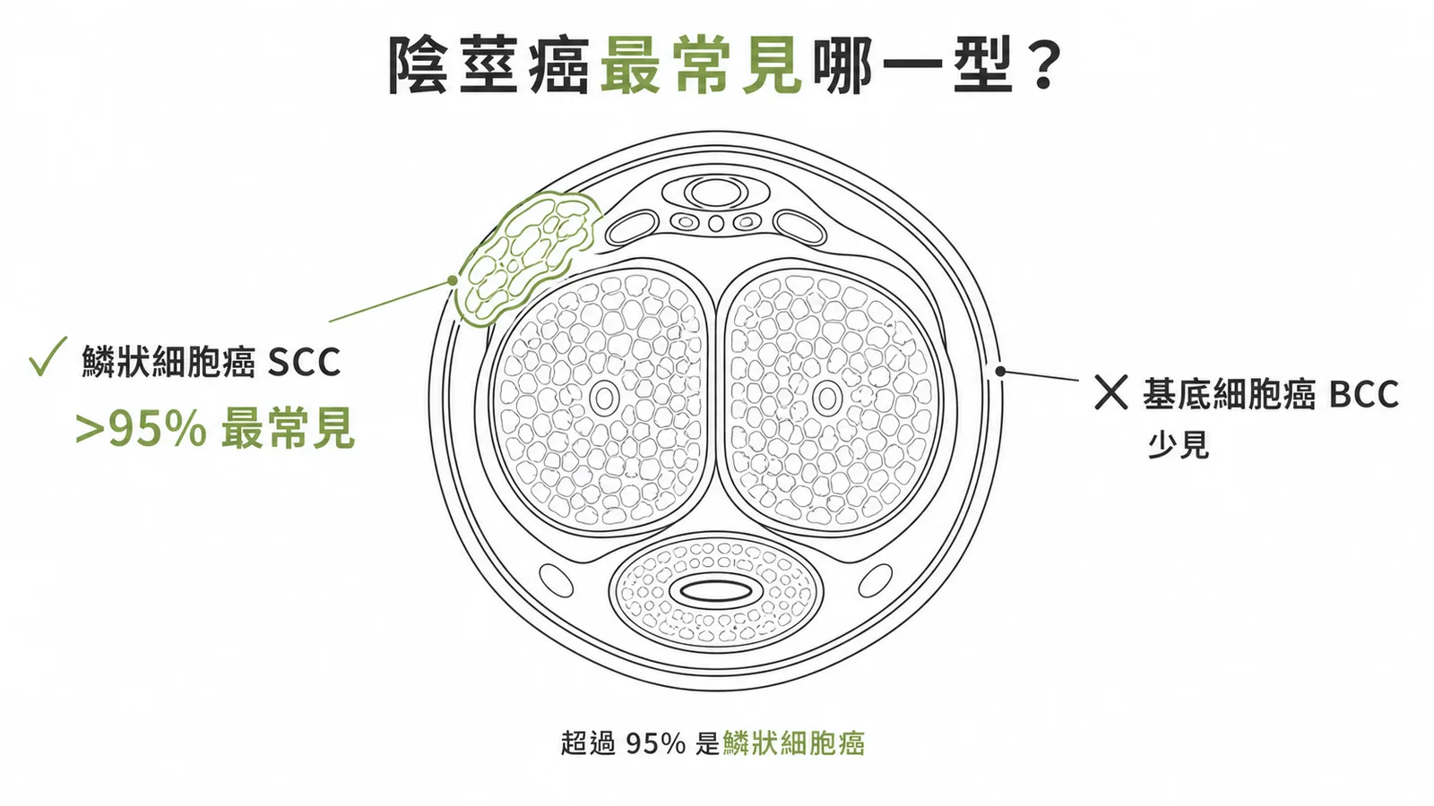 陰莖癌最常見類型為鱗狀細胞癌SCC而非基底細胞癌BCC示意圖