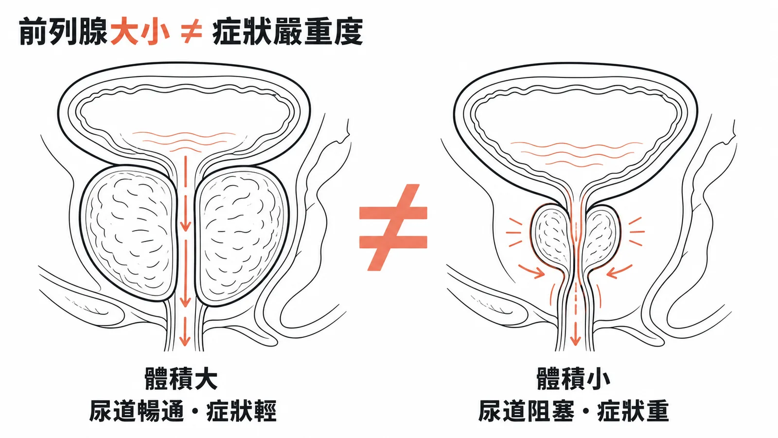 前列腺大小不等於症狀嚴重度BPH示意圖