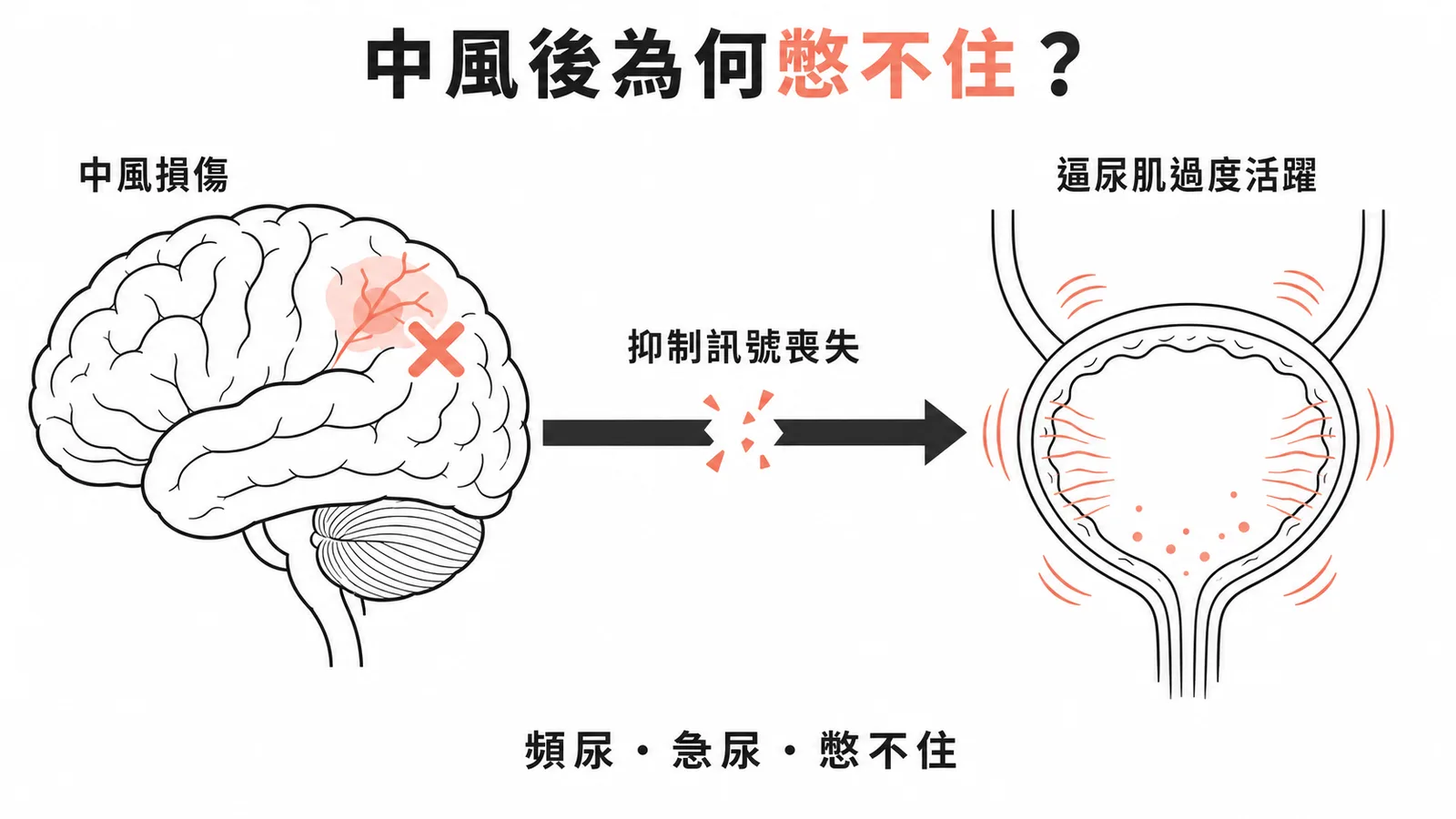 中風後膀胱逼尿肌反射亢進機轉示意圖