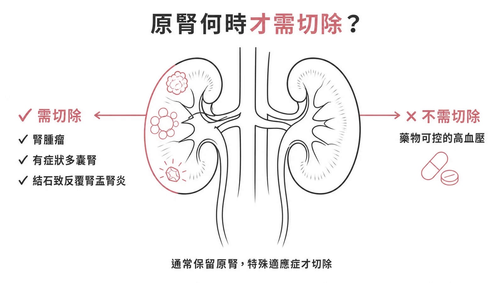 腎移植前原腎切除適應症與藥物可控高血壓不需切除示意圖