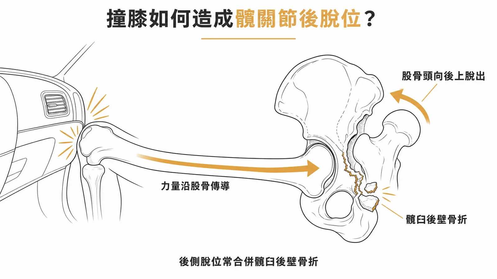儀表板撞擊造成後側髖關節骨折脫位機轉示意圖