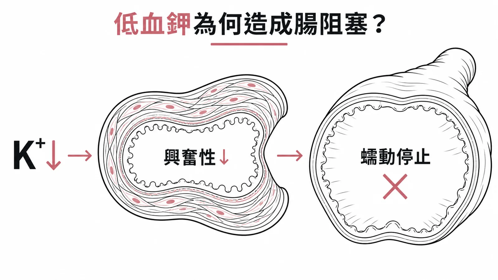 低血鉀造成腸阻塞機轉：K⁺↓ 導致腸道平滑肌興奮性下降、蠕動停止