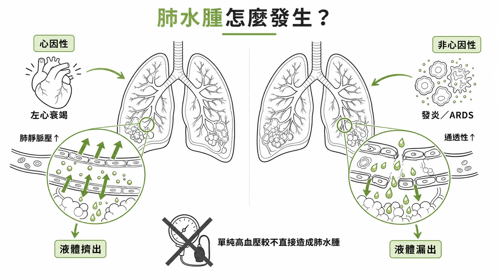 肺水腫心因性與非心因性兩大機轉示意圖