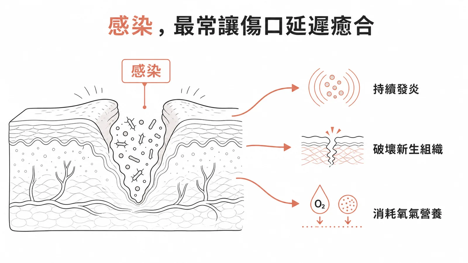 傷口感染引起持續發炎破壞新生組織是癒合延遲最常見原因