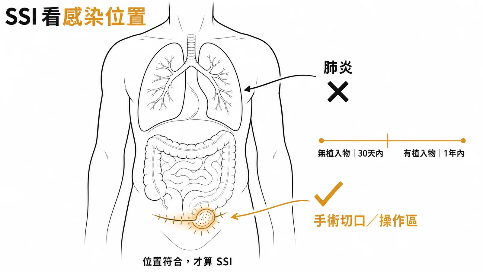 SSI定義看感染位置與時間範圍肺炎敗血症不算SSI