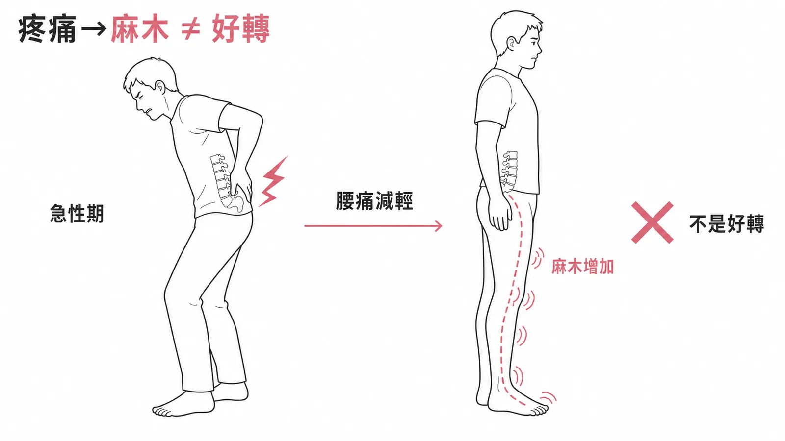 腰椎椎間盤突出：疼痛緩解但麻木增加並非好轉，可能是神經功能惡化